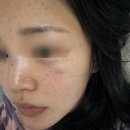 시장로 | 블리비 부평점 리쥬란·스킨보톡스 주관적 후기(내돈내산 매우 만족스럽지 않았던 경험)