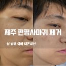 진솔한의원 | 제주편평사마귀 제거, 레이저 대신 침으로 말끔히 없앤 진솔 후기