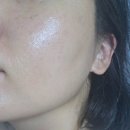 아르페 다크스팟 솔루션 마이크로팁 멀티 기미 니들 패치