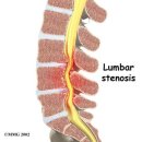 척추협착증(spinal stenosis)의 원인과 치료법 이미지