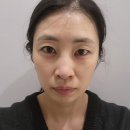 샤넬멍 | 강남역 피부과 엑소샤넬 관리 후기, 물광관리 통증 일주일 효과