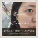 점.하나 | 부산 점제거 잘하는곳 내돈내산, 얼굴 점빼기 후기(침제거 장점, 경과)
