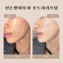 신논현피부과 포트라리프팅 후기 다운타임 없이 받은 리프팅 솔직후기