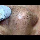 [약혐] blackhead removal 이미지