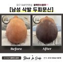 도트인스칼프