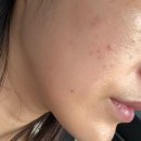 메디프라자 | 인천 서창동 피부관리 맛집 소미왁싱 소미뷰티솔루션 | 트러블피부 1:1맞춤 메디블링프로그램