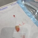 100세 치과의원 | [2025 블챌 / 수원 일상] &#34;퍼스트 사랑니 치과의원&#34;에서 2번째 발치 (내돈내산)