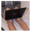 Laptops cause ‘toasted skin syndrome’ 이미지