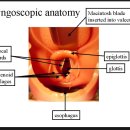 Endotracheal Intubation by Direct Laryngoscopy 이미지