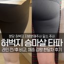 분당 허벅지 지방분해주사 달스 주사, 한달차 후기(전, 후 비교 사진 있음)