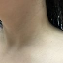 브로우 현 | 부천 쥐젖, 편평사마귀 무제한 '현브로우' 실제 후기