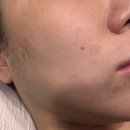 레아약국 | 부산편평사마귀 제거 잘하는 피부과 솔직후기