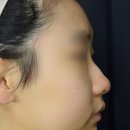 (주)케이스코 | 엘란쎄 필러를 활용한 비수술 코성형 후기(ft. 전후 비교)