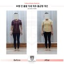 수지척추체형교정