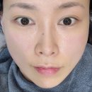 강동피부과 통증없던 셀리뉴 300샷 효과 한달후기 써마지 비교