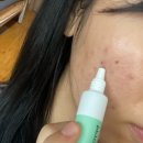 여드름, 문제성피부 세럼 추천 /제품 솔직 후기/보정 없는 전후 사진 첨부 ] 깨끗한 피부 만들기 / 미백...