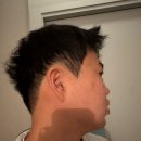 브이맨 | 이중턱 없애기 고민하다 선택한 브이맨 달걀주사 후기｜턱살빼는법 실제 변화