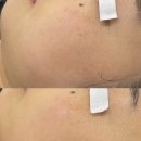 부천 피부관리 ㅣ 피부 혹한기 겨울에는 수분관리 LDM 물방울 리프팅 써니뷰티 후기