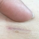 삼성생명보험(부평중앙병원 옆) | 담석증으로 인한 증세 및 인천 부평성모병원 담낭제거 로봇수술 후기(음식, 흉터)