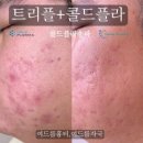 콜드 플라 송파 이미지