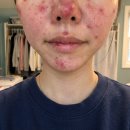 구원메디 | 메디옥실 레드스팟 티트리 세럼 크림 사용전후 후기