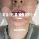필링랩 | 창원 여드름 압출 잘하는곳 :: 상남동 르네아 바이더랩 _ 입가 턱 트러블 약초필링 관리 후기