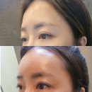 선릉역피부과 누브의원 이마필러 솔직후기