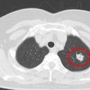고립성 폐결절 및 (흉부 전선량 폐 CT) 이미지