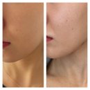 장지역 | 장지역 피부과에서 쥬베룩 스킨부스터 내돈내산 후기 (효과, 가격, 유지기간)