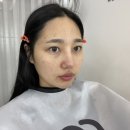 루비 | 오리지널 루비레이저 장비로 시술하는 영등포 피부과 루비레이저 후기!! / 두달 기다려서 다녀옴...