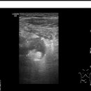 perforated appendicitis 이미지