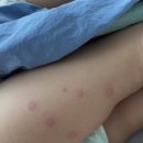 비클린이비인후과의원 | [아기 감기] 두정동 성성동 이비인후과 후기 - 약부작용, 두드러기, 홍반