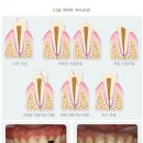 골절 [치아파절 제외] 분류표Ⅱ와 골절분류표Ⅱ의 비교[치아파절 S02.5는 제외] 이미지