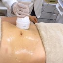 이블리 | 압구정피부과 바디온다 복부관리 내돈내산 효과 통증 솔직후기