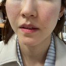 포레스트성형외과 | 팔자주름 고민 끝.. 포레스트 리프팅 1회 솔직후기