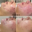 세선약국 | (피부과약부작용) 성인여드름 그리고 완치 후기.