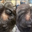 믿고 받는 에코레비 하남동 탈모관리 1회차→11회차 후기 , 에코레비 헤어앤스파 광주하남점 세빈실장