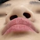 G.d라인치과기공소 | 몽이의 성형 일기] 구순열 코 수술 상담 후기 | 병원별 비교 리뷰