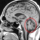 소뇌위축증 척수소뇌실조증 원인 증상 방법 소뇌의 중요성 이미지