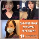 처음보다 더 | 쌍수 매몰 재수술 붓기가 처음보다 더 심한지 후기로 확인