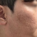 영광한의원 | 강남 피부과 한의원 여드름패인흉터 제거 새살침 치료 1회차 후기