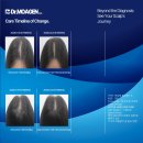 광고마을 맞은편 | 부산 20대 여성 정수리 가르마 탈모 12회 관리 닥터모아젠 리얼후기