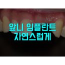 앞니를 상실 하였다면 부산앞니임플란트 잘하는곳으로 (78)