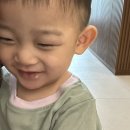 17개월 아기 눈두덩이 찢어진 부위 봉합 및 실밥 제거 후 레이저치료 1차 ( 서초서울마더스성형외과의원 )