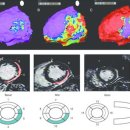 D00493 | Case_Study_625:심근경색으로 입원한 64세 남성_고주파 심실성빈맥 절제 부위의 미세혈관 폐색 유사 병변