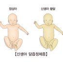 신생아 황달 (Neonatal jaundice) 이미지