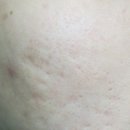 남지약국 | 약국 색소침착크림 멜라토닝크림 한달 사용 후기