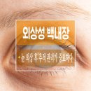 외상성 백내장 눈 외상 후 추적 관리가 중요하다