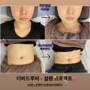 비비드루비 | [경기/군포] 산본역 얼굴부터 몸매까지 한번에 완벽 변신 ‘비비드루비’ (리프팅+에너지테라피 솔직후기)
