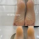 개신초교 | 뒷꿈치 발각질 케어 완벽후기!(패디플래닝)